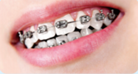 牙齿矫正方法有哪些，该如何选择牙齿正畸方法